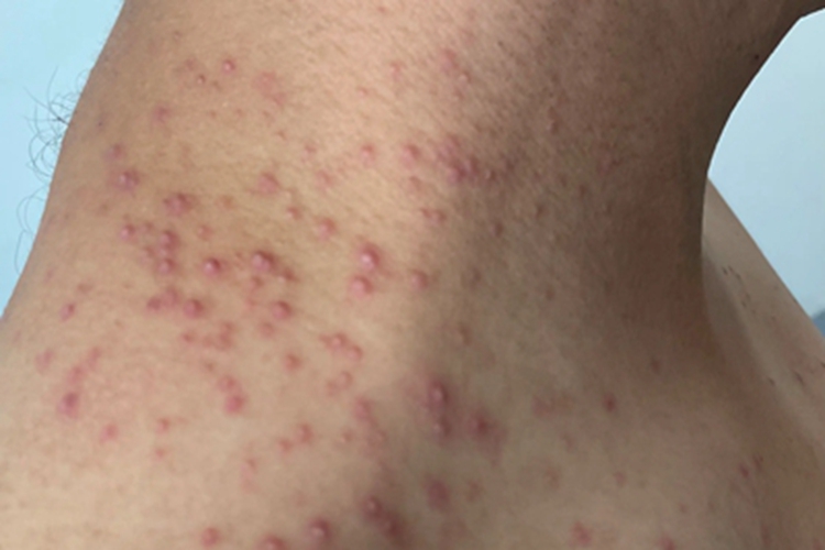 马拉色菌毛囊炎肩部脓疱图