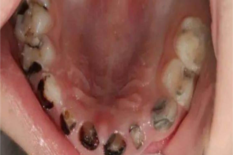 中龋牙齿有洞和黑斑图 中龋牙齿有洞和黑斑图