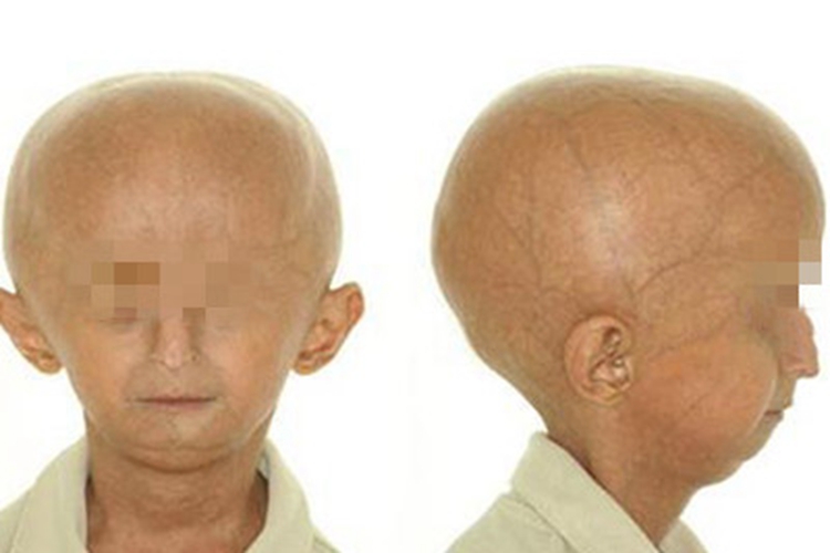 儿童早老症头大变形图 儿童早老症头大变形图