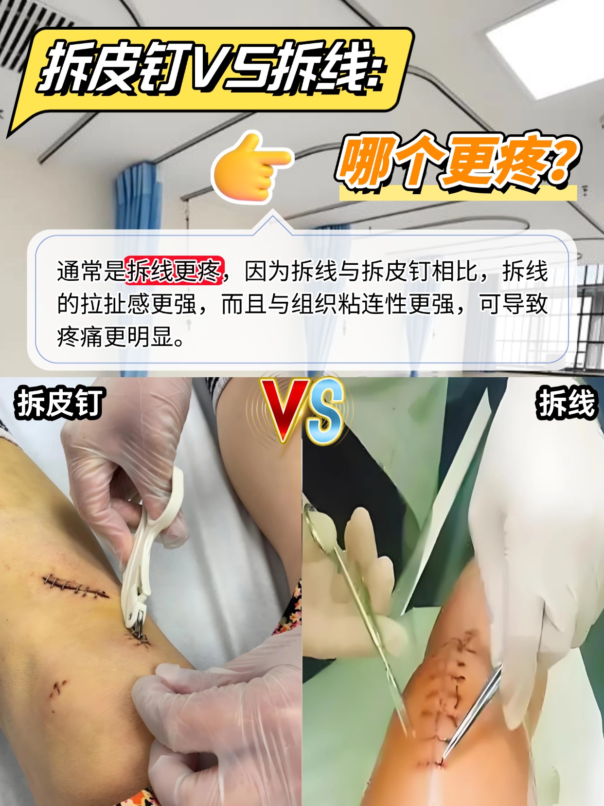 拆皮钉VS拆线:哪个更疼?