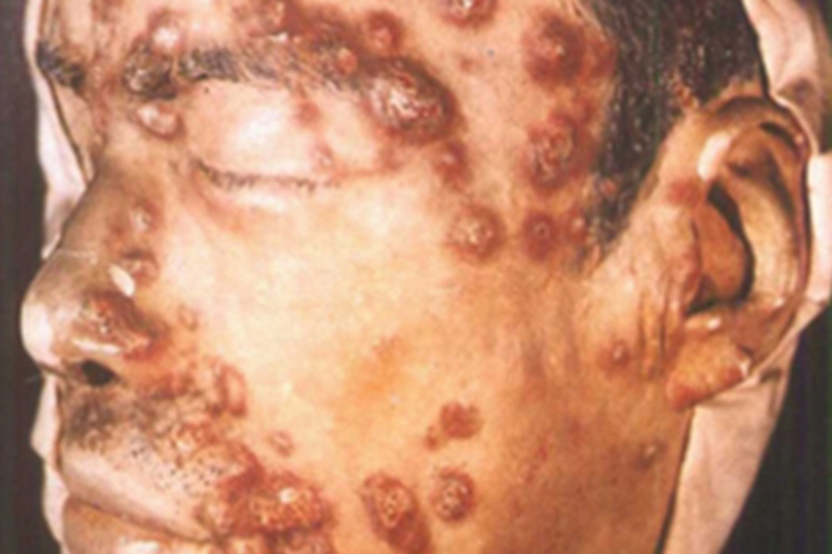 男性结节性梅毒疹面部结痂图 男性结节性梅毒疹面部结痂图