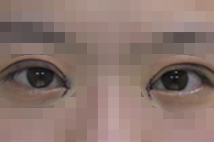 开眼角术后第一天恢复图