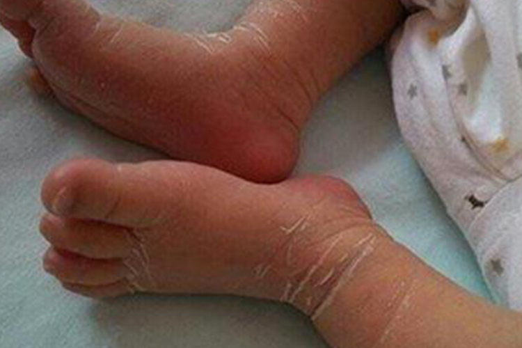 宝宝鳞屑角化型足癣初期症状图