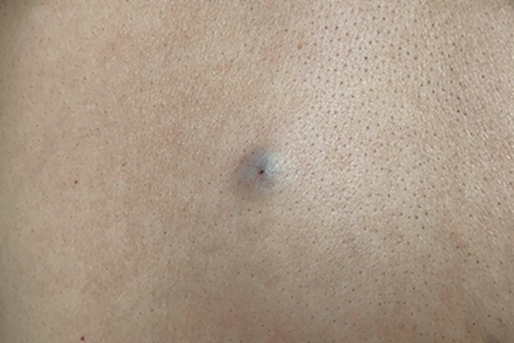 皮脂腺囊肿背部症状图