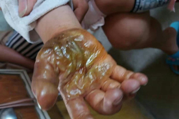 电烧伤手掌渗液图