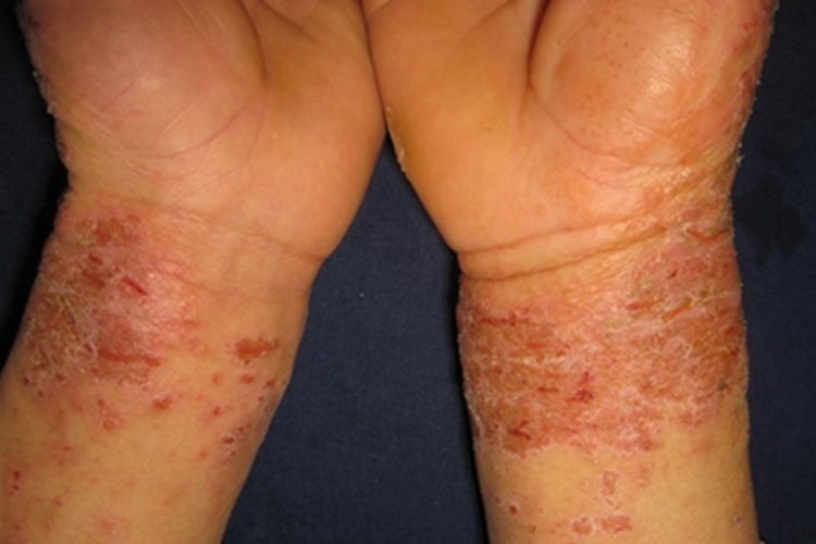 接触性皮炎手腕结痂图