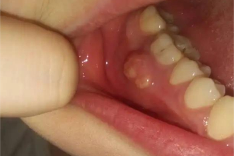 急性化脓性根尖周炎口腔症状图