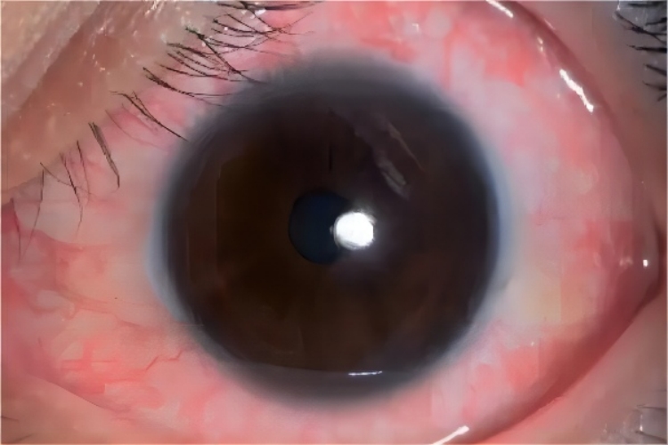 结膜炎眼红图 结膜炎眼红图