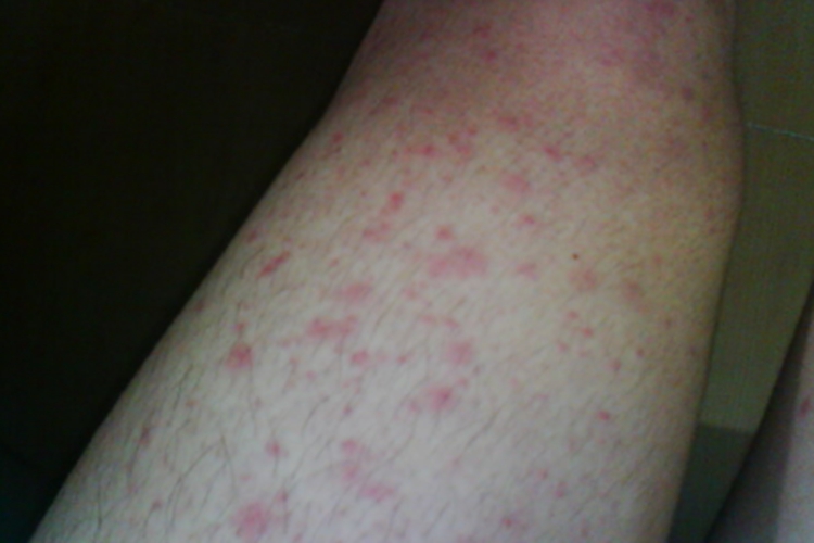 红绀病大腿症状图