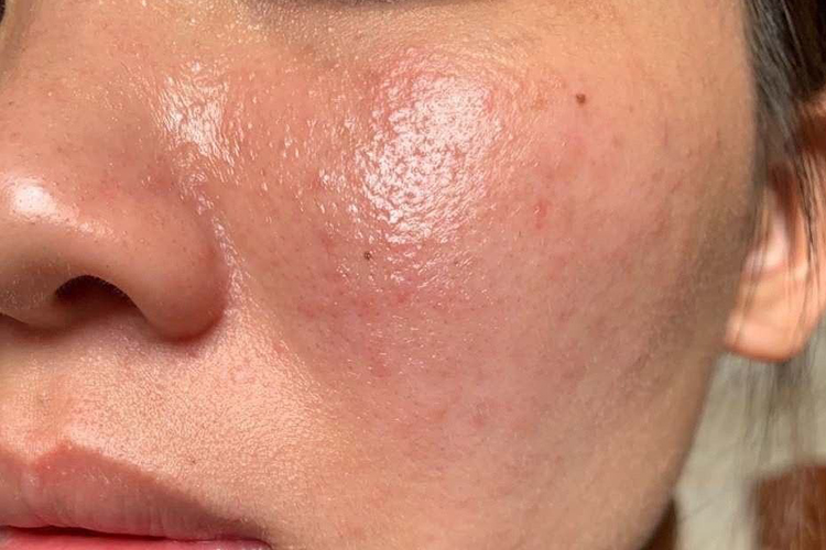 脸部排激素出疹子图