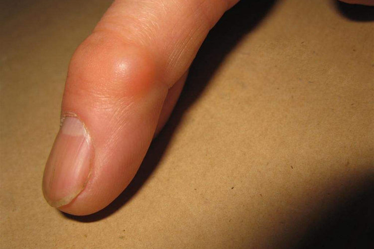 食指黏液性囊肿图