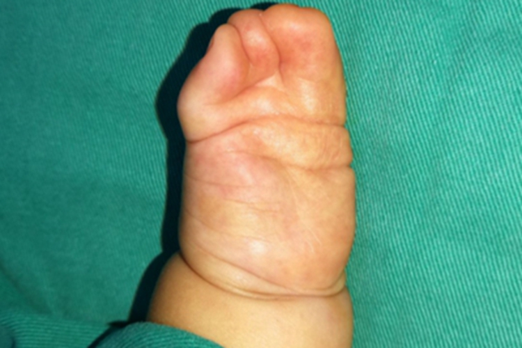 并指畸形手指全部合并图 并指畸形手指全部合并图