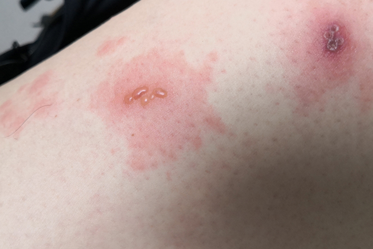 缠腰龙最早期的水疱图