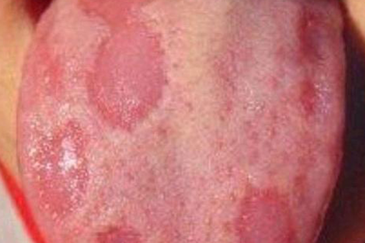 地图舌图 地图舌图