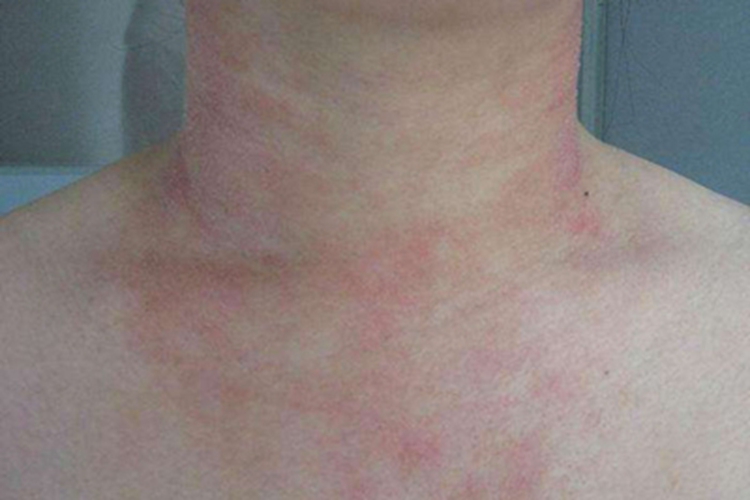 光毒性接触性皮炎胸部发红图
