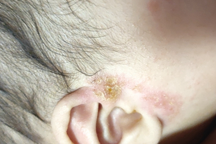 婴儿脂溢性皮炎黄痂图