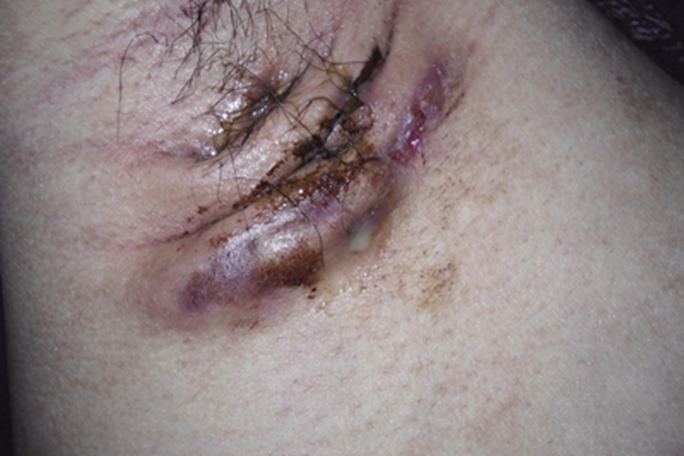 化脓性汗腺炎腋窝黄痂图