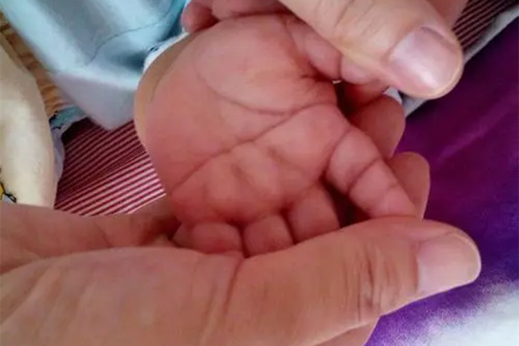 5P-综合征症状图