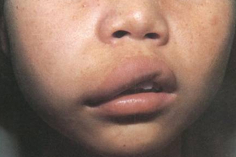 海绵状淋巴管瘤上嘴唇肿胀歪斜图