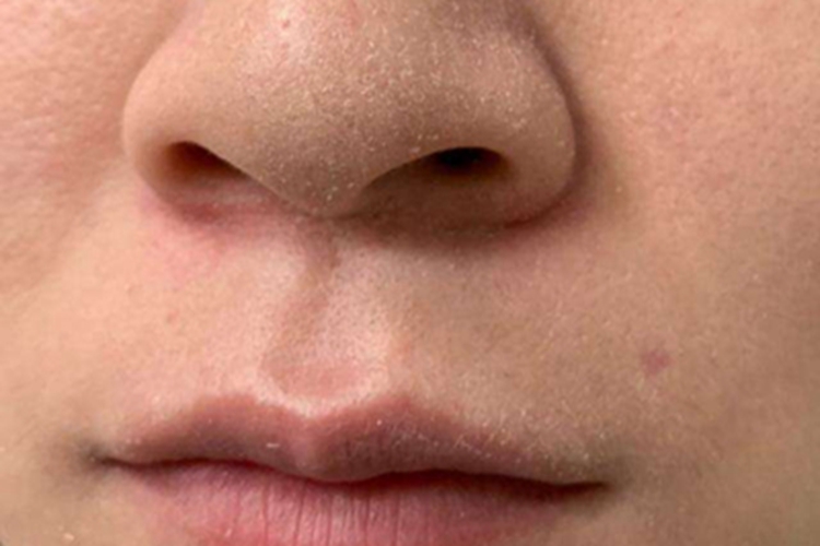 皮肤干燥症面部症状图