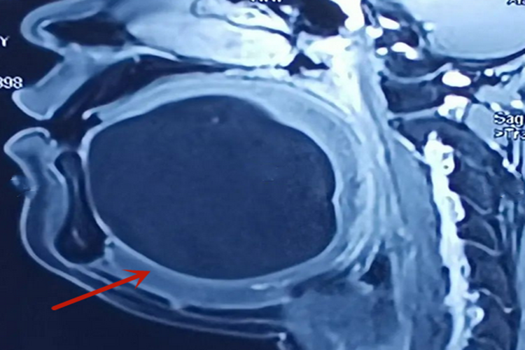 皮样囊肿影像图