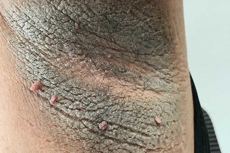 恶性黑棘皮病腋窝很黑图