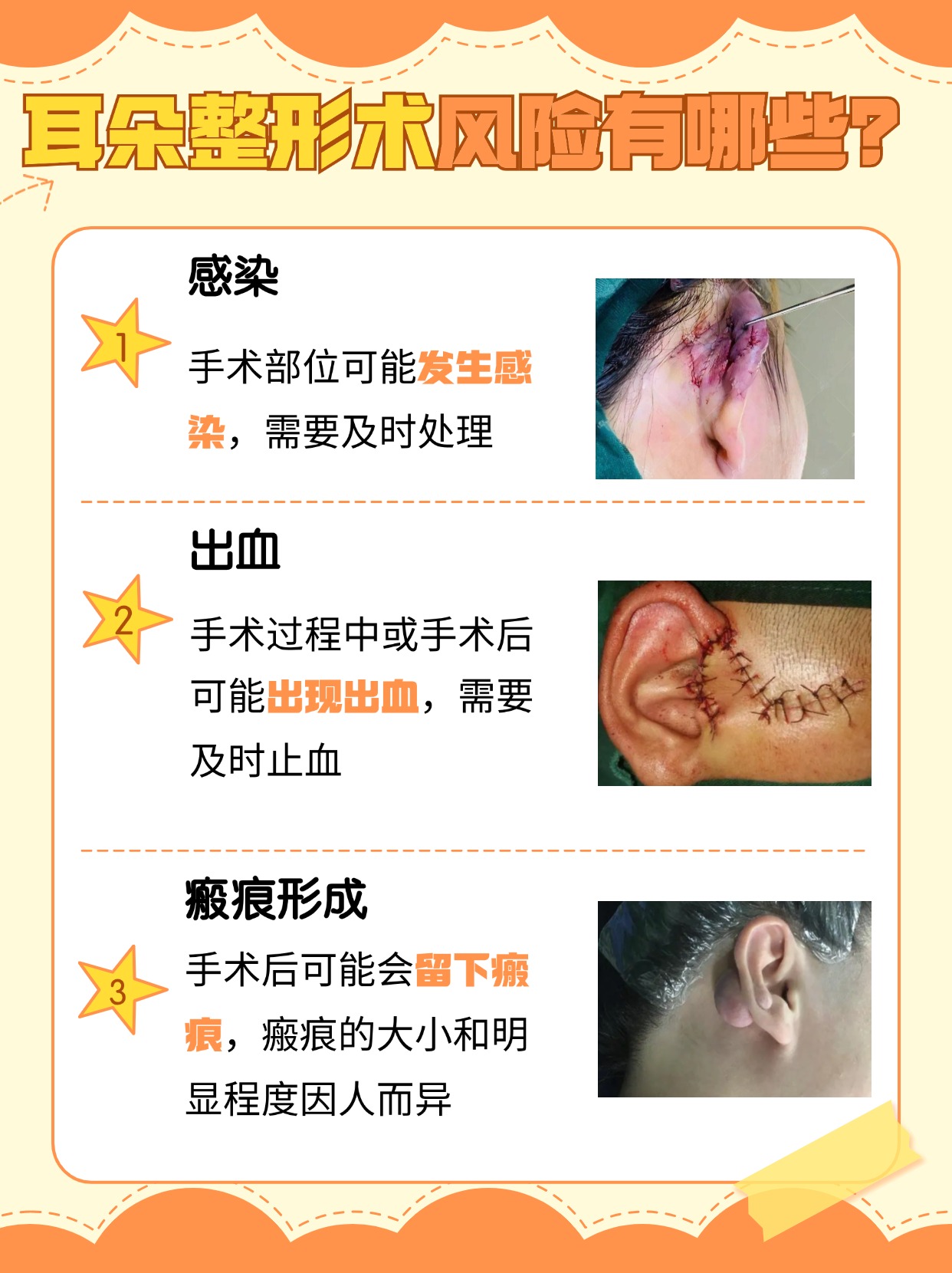 耳朵整形费用解析:手术价格大公开