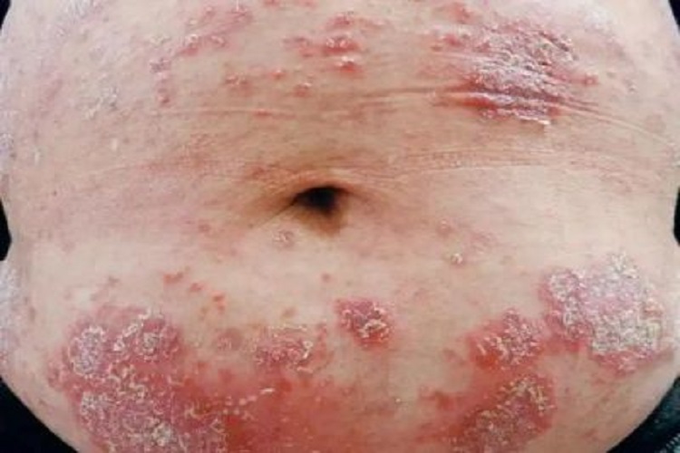 IgA天疱疮左腹症状图