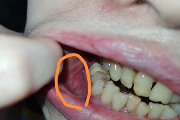 扁平苔藓口腔黏膜潮红有白斑图 扁平苔藓口腔黏膜潮红有白斑图