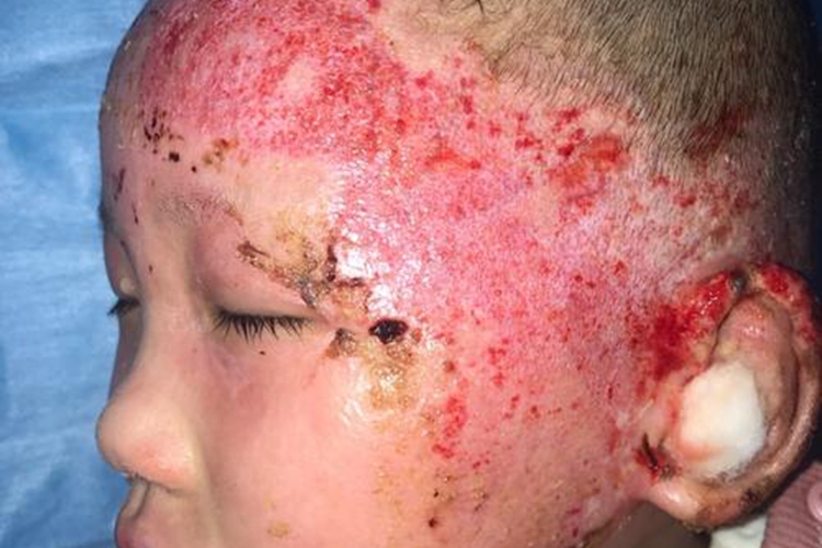 深二度烧伤脸部图