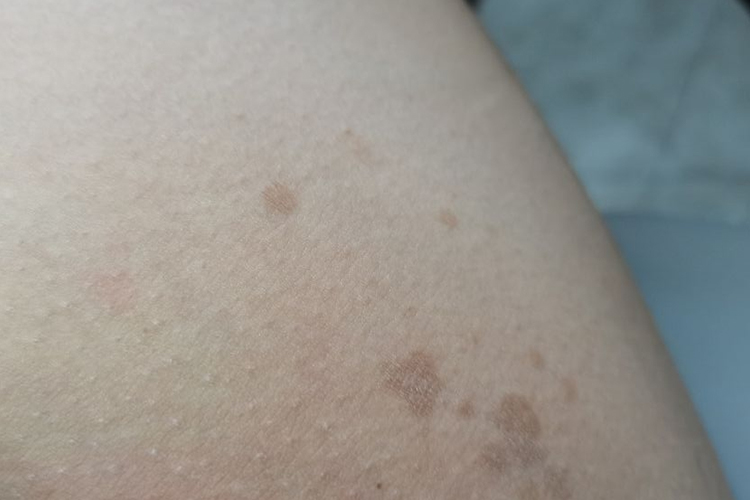 大腿内侧咖啡斑 大腿内侧咖啡斑