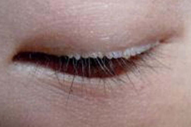 类脂质蛋白沉积症眼睑症状图 类脂质蛋白沉积症眼睑症状图