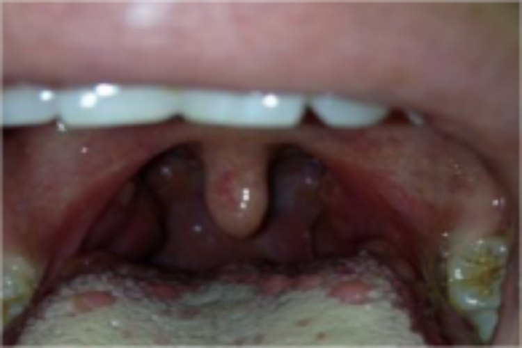 正常轮廓乳头图