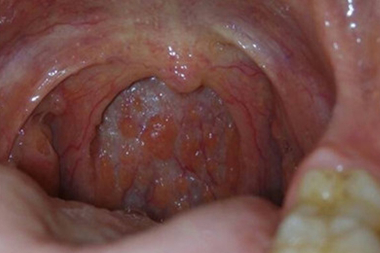 艾滋病初期咽喉炎水肿图