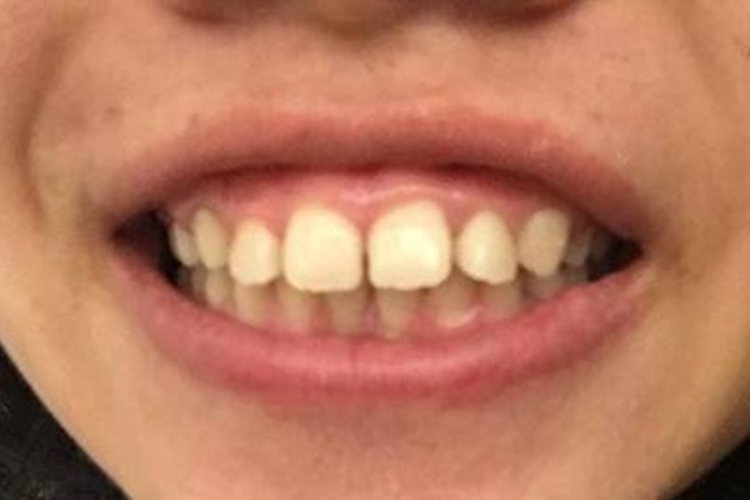 龅牙露齿龈图 龅牙露齿龈图