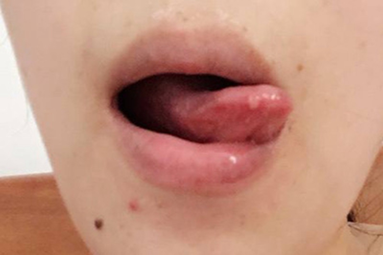 舌癌舌尖上溃烂图