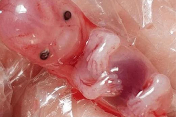 妊娠8周后自然流产图 妊娠8周后自然流产图