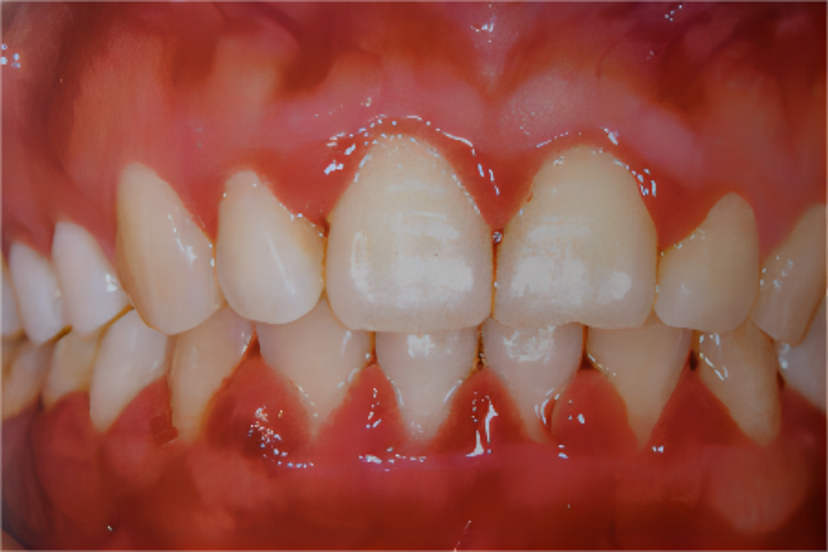 牙龈变黄溃疡图