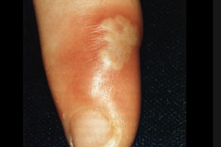 脓性指头炎手指肿胀图 脓性指头炎手指肿胀图