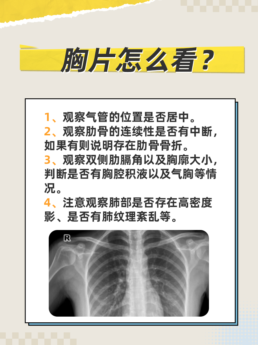 胸片解读秘籍：轻松看懂你的胸片报告！