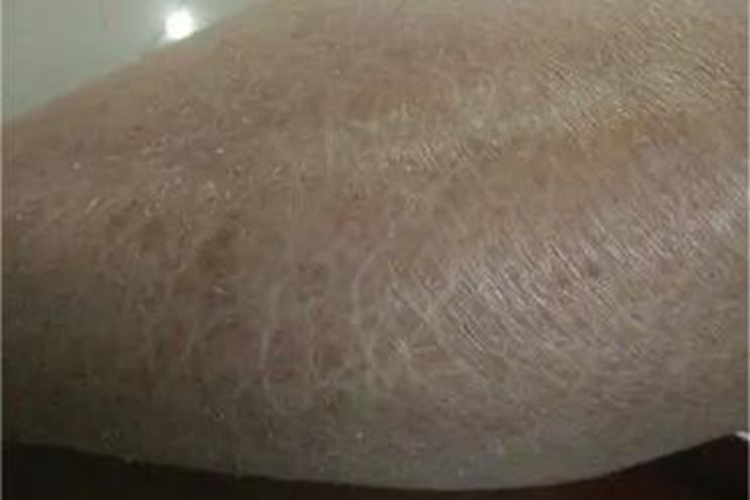 老年性皮肤萎缩裂纹图