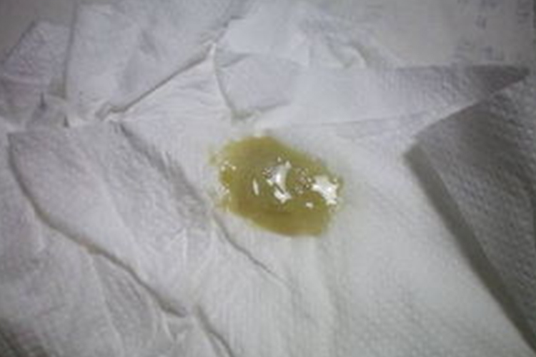 肺炎黄绿色痰图