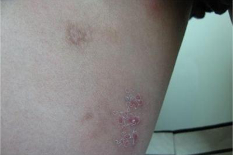 单纯疱疹大腿内侧脱皮红斑图