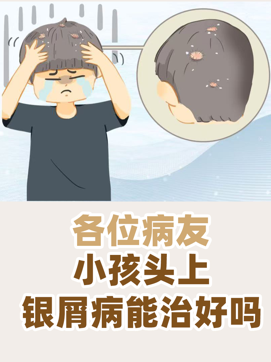 小孩头上银屑病能治好吗?家长别慌!