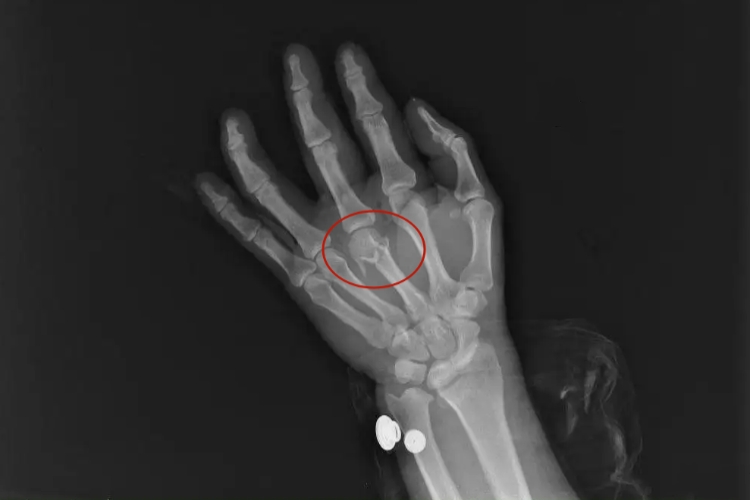 手掌粉碎性骨折图