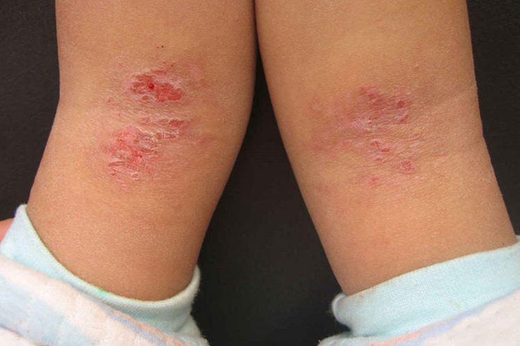 吃鱼腥草过敏变应性皮炎图