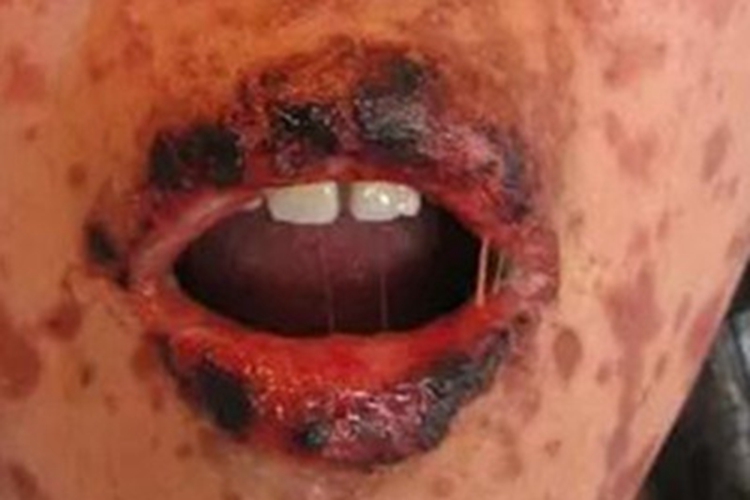 多形红斑嘴唇结痂图