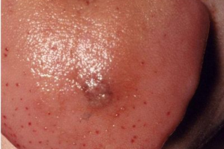 正中菱形舌炎疙瘩图