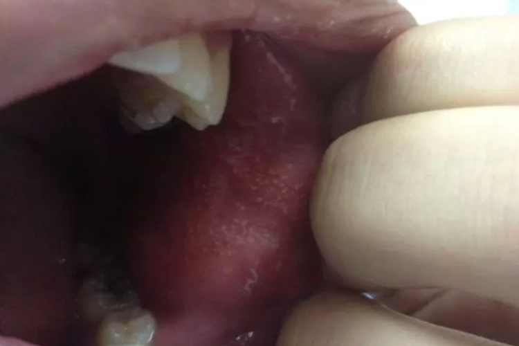 口腔迷脂症图 口腔迷脂症图