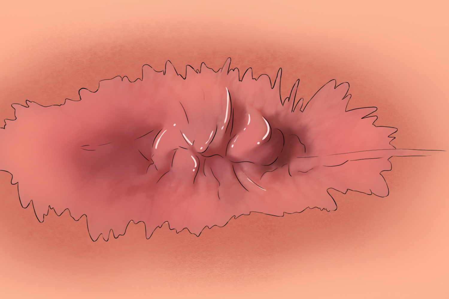 肛周皮肤湿疹图